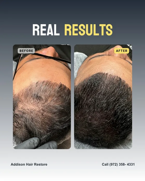 Addison Hair Restore before-and-after social graphic showing scalp density improvement, headline “Real Results,” with contact Call (972) 358-4331.